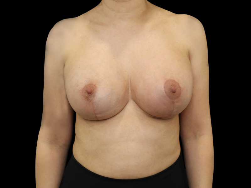 Breast Lift With Implant Patient 8 Front After