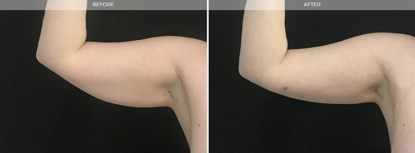 Arm Liposuction New Jersey