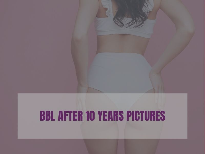 BBL After 10 Years Pictures smita plastic surgery