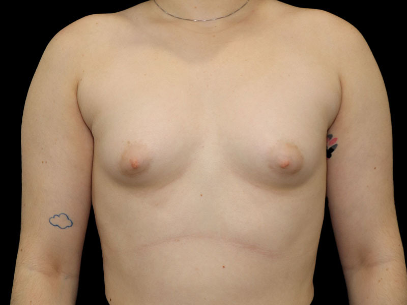 New Jersey Breast Augmentation Front Before