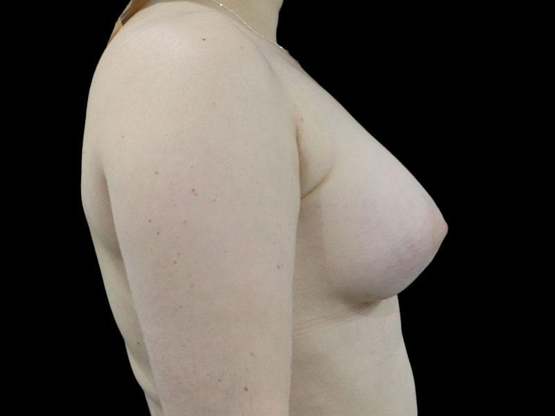 New Jersey Breast Augmentation Front After