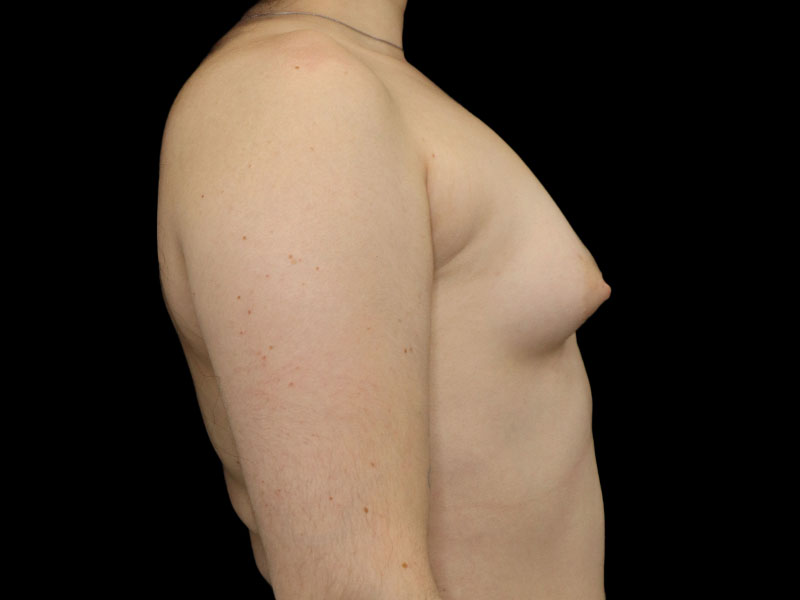 New Jersey Breast Augmentation Front Before