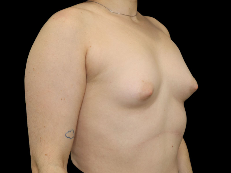 New Jersey Breast Augmentation Front Before