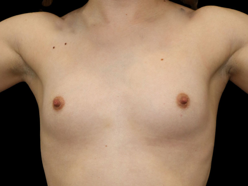 New Jersey Breast Augmentation Front Before