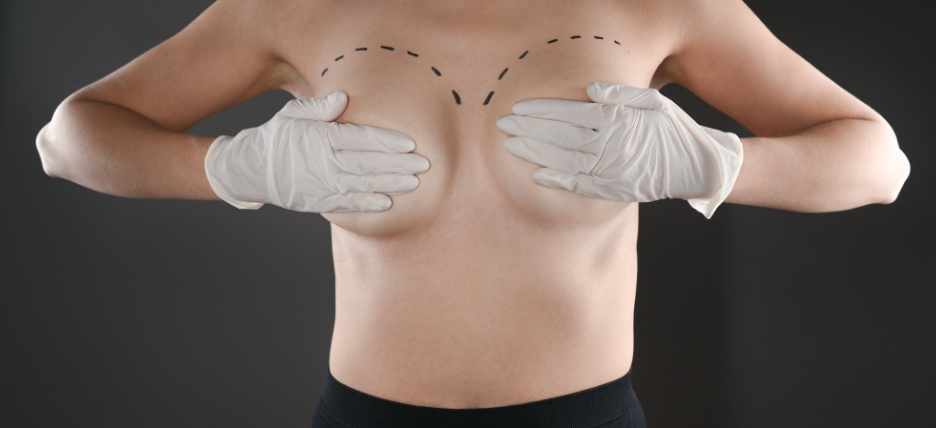 Breast Augmentation Before And After