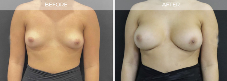 Breast Augmentation Before and After Linwood NJ
