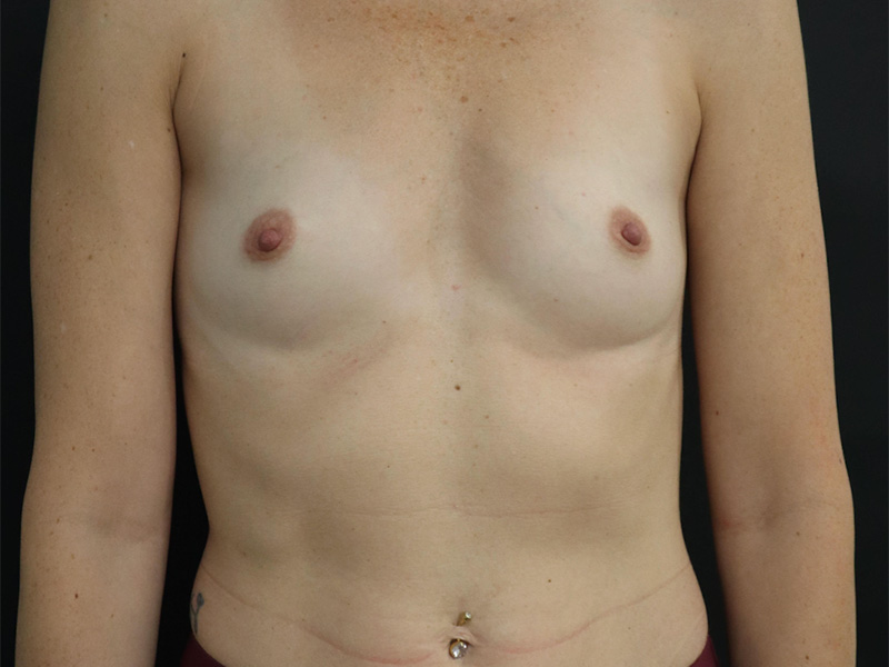 Breast Augmentation New Jersery Before Front