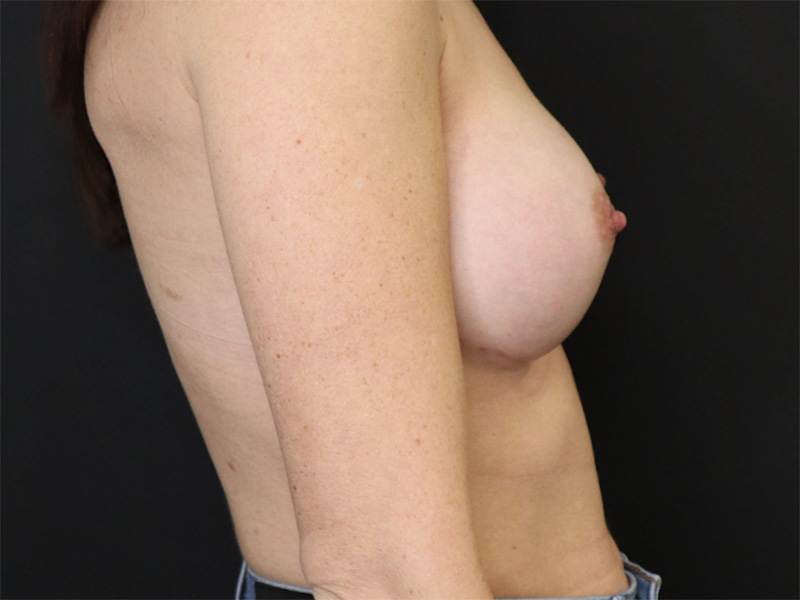 Breast Augmentation New Jersery Lateral After