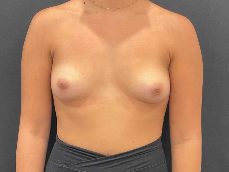 Breast Augmentation New Jersey Patient 12 Front Before