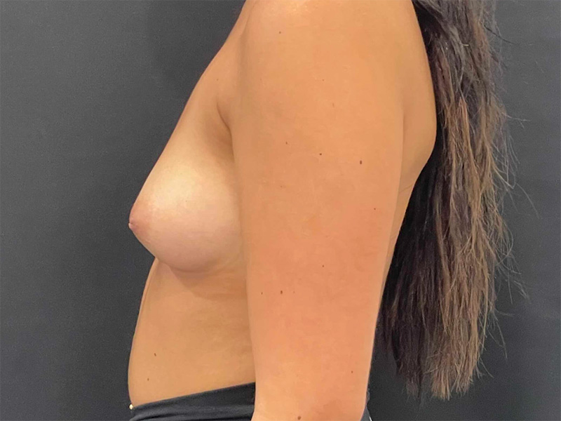 Breast Augmentation New Jersey Patient 12 Lateral Before