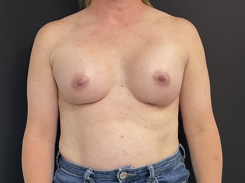 Breast Augmentation New Jersey Front After