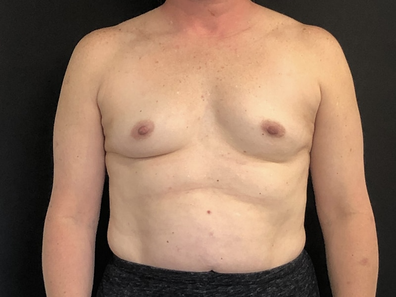 Breast Augmentation New Jersey Front Before