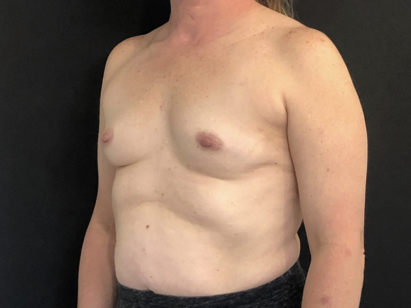 Breast Augmentation New Jersey Oblique Before
