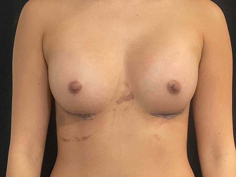 Breast Augmentation New Jersey Photos Front After
