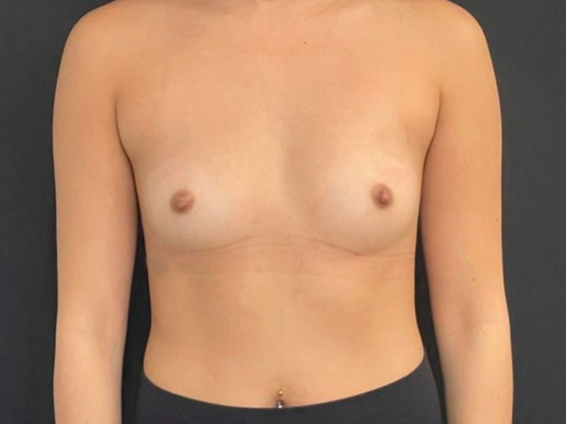 Breast Augmentation New Jersey Photos Front Before