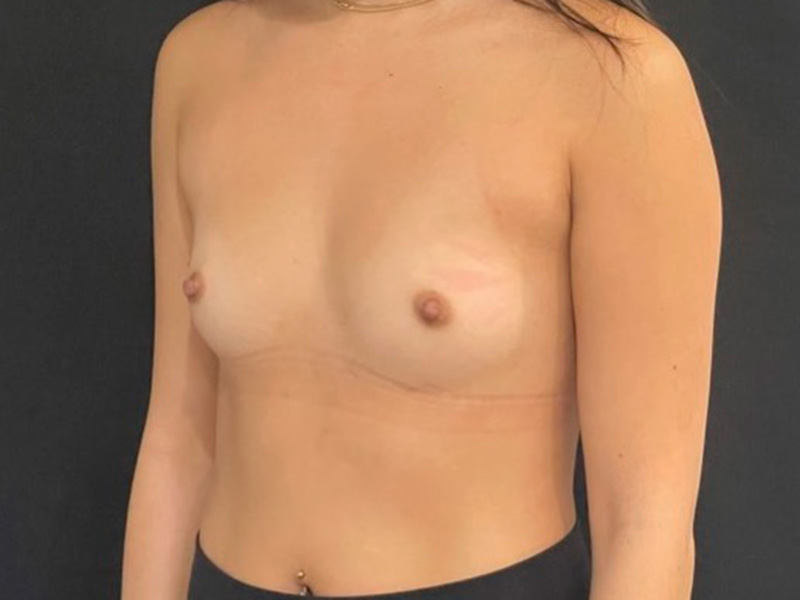 Breast Augmentation New Jersey Photos Oblique Before