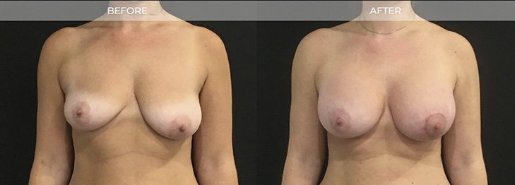 Breast Augmentation in Northern NJ
