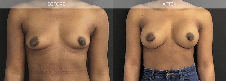 Breast Implants Haddonfield NJ