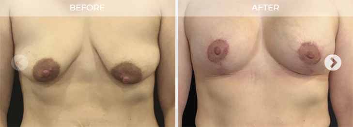 Breast Lift NJ