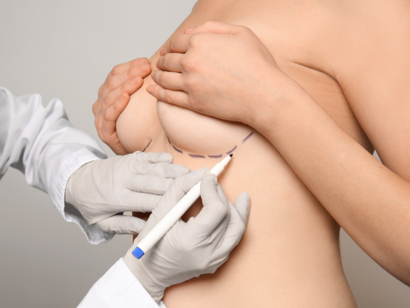 Breast Lift Recovery Time How to Plan For Your Surgery