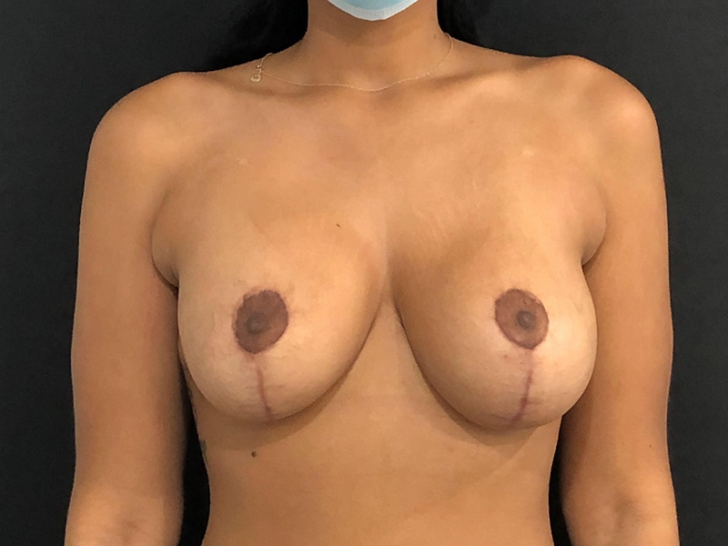 Breast Lift W Implant Anterior After