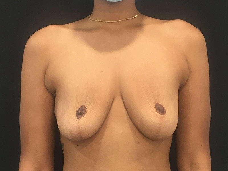 Breast Lift W Implant Anterior Before