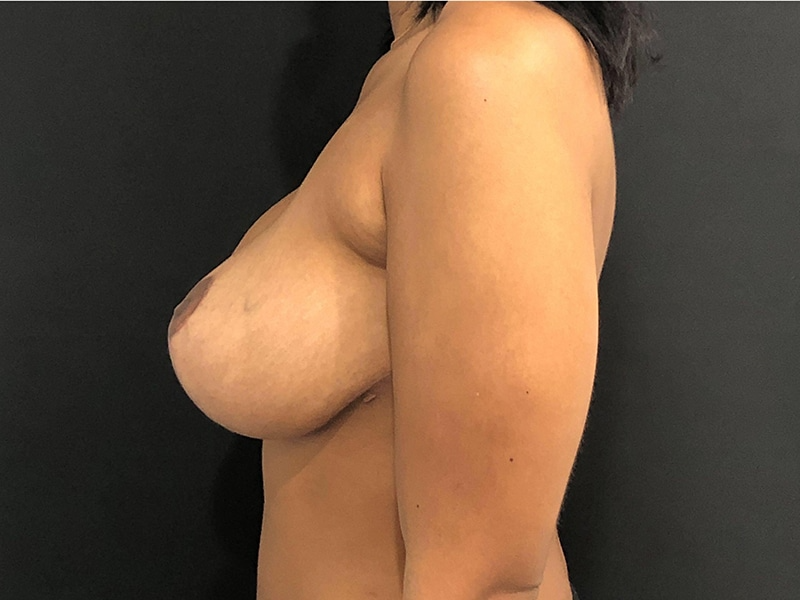 Breast Lift W Implant Lateral After