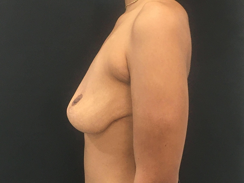 Breast Lift W Implant Lateral Before