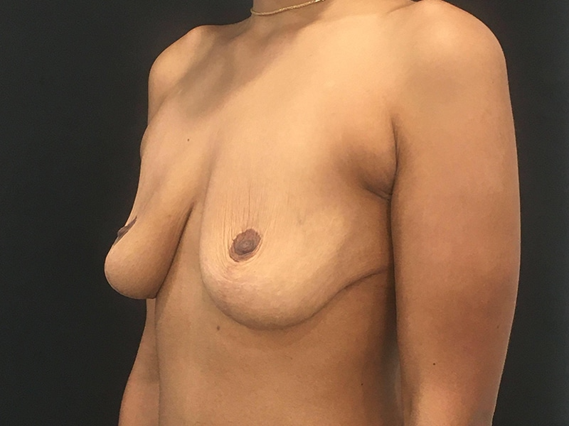 Breast Lift W Implant Oblique Before 1