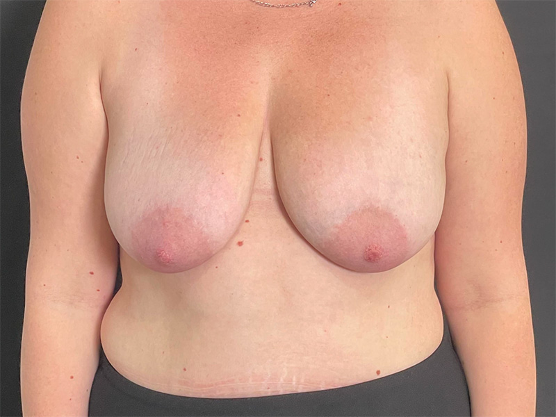 Breast Lift With Implant Patient 8 Front Before