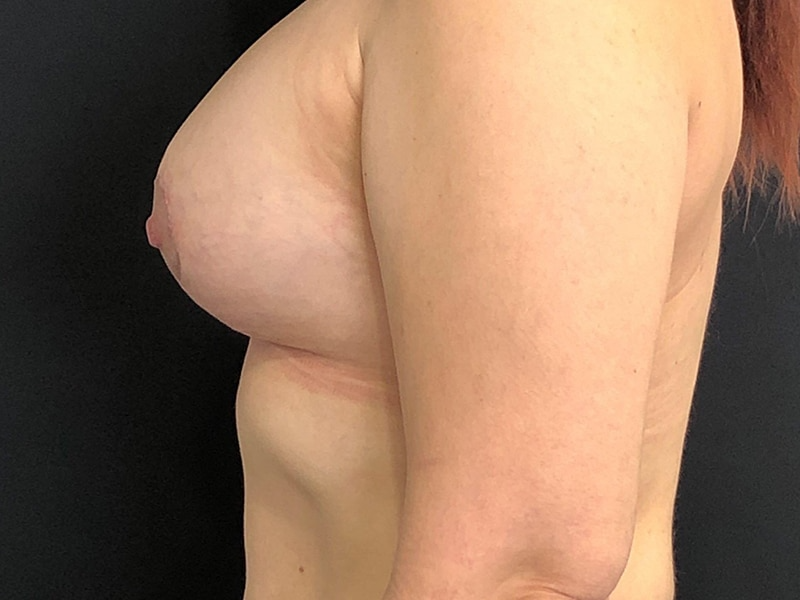 Breast Lift With Implant Lateral After
