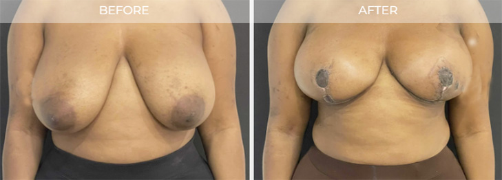 Breast Reduction Before and After New Jersey
