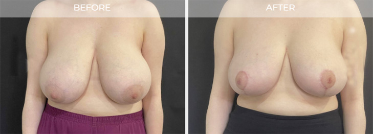 Breast Reduction NJ