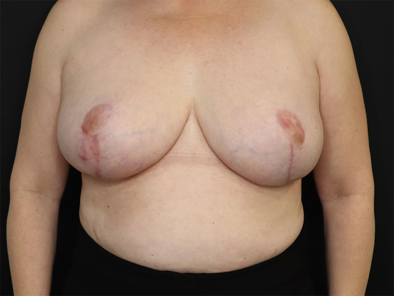 Breast Reduction New Jersey Patient 4 Front After