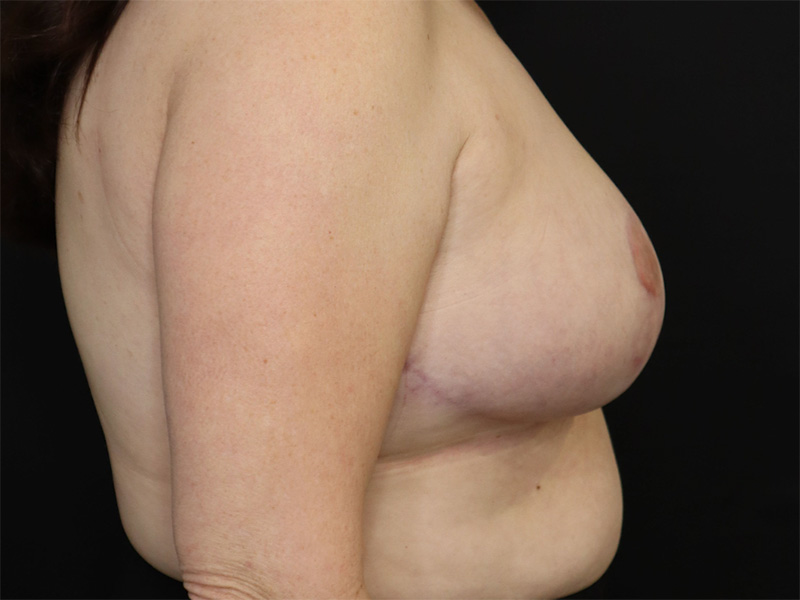 Breast Reduction New Jersey Patient 4 Lateral After