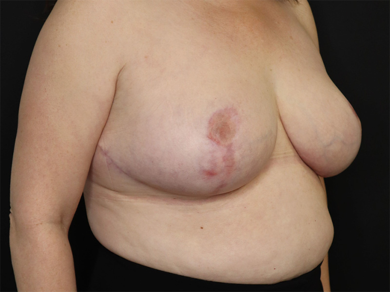Breast Reduction New Jersey Patient 4 Oblique After