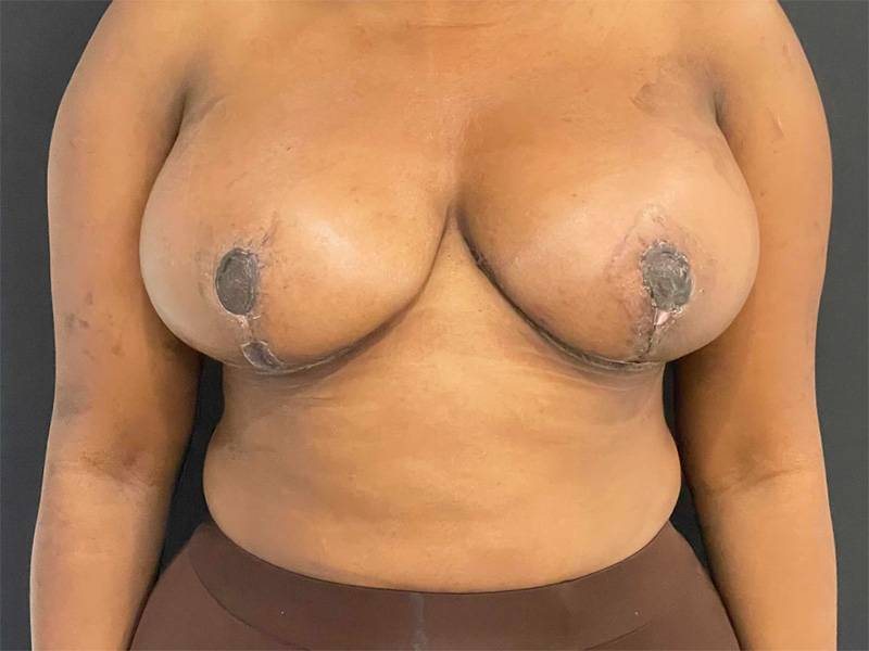 Breast Reduction New Jersey Patient 5 Front After