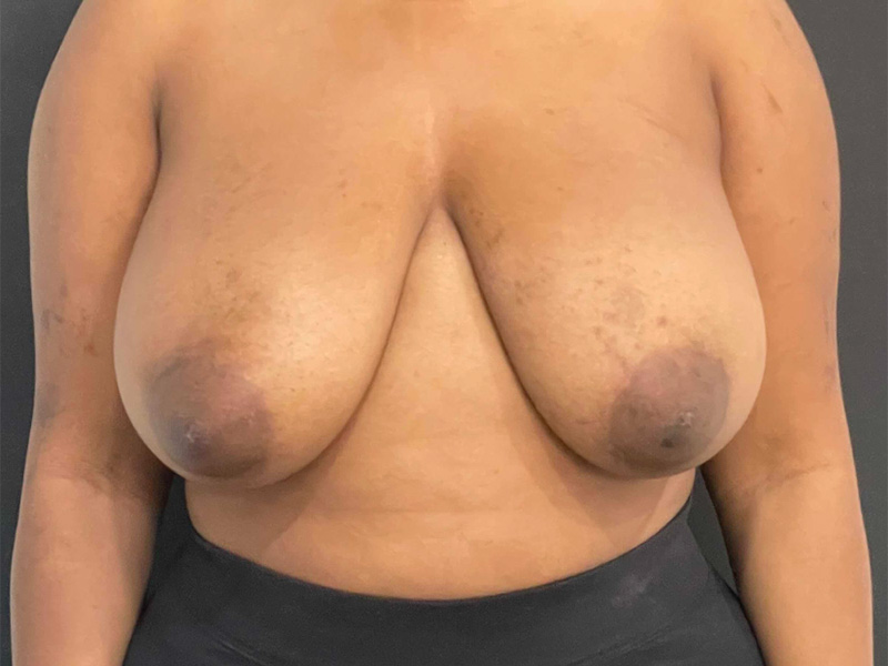 Breast Reduction New Jersey Patient 5 Front Before