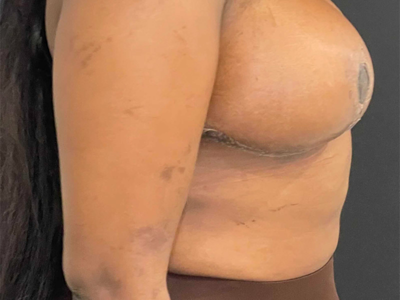 Breast Reduction New Jersey Patient 5 Lateral After