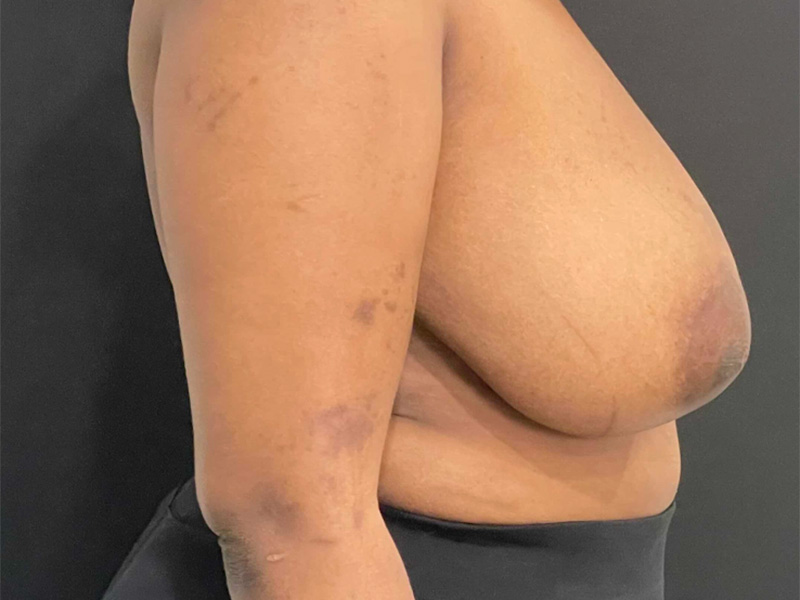 Breast Reduction New Jersey Patient 5 Lateral Before