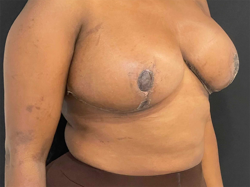 Breast Reduction New Jersey Patient 5 Oblique After