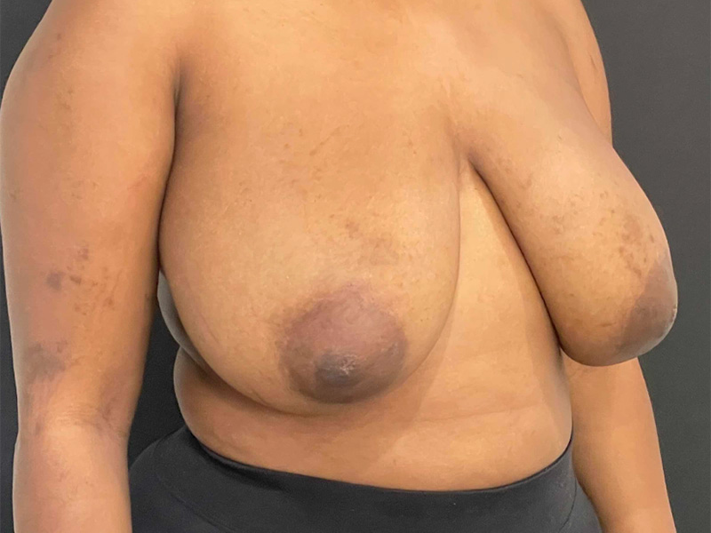 Breast Reduction New Jersey Patient 5 Oblique Before