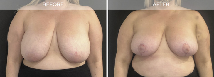 Breast Reduction New Jersey