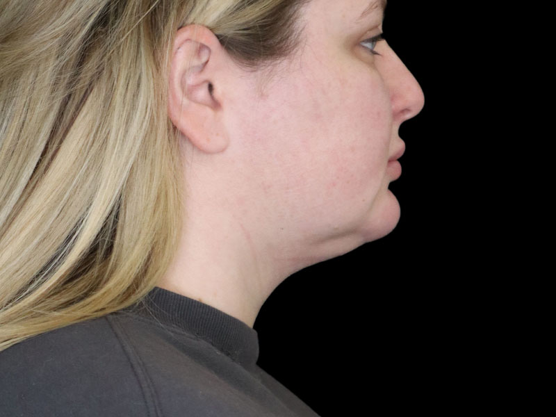 Chin Liposuction Photos Front After