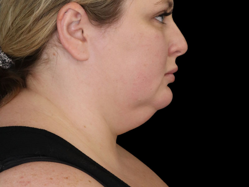 Chin Liposuction Photos Before