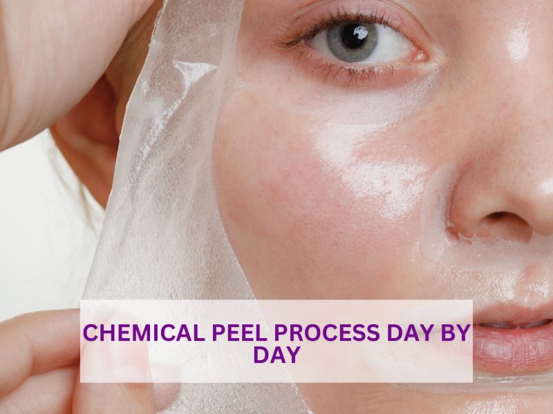 Chemical peel Process Day by Day Chemical peel Process Day by Day