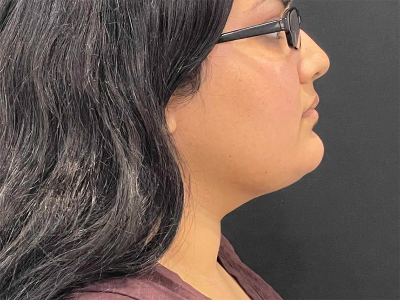 Chin Liposuction After Right 1