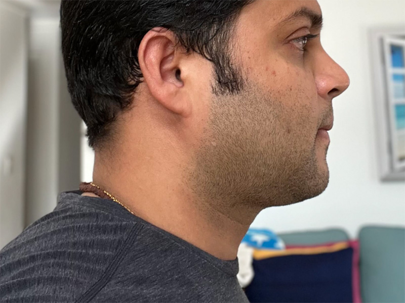 Chin Liposuction After Right