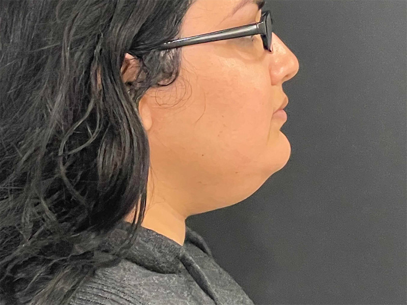 Chin Liposuction Before Right 1
