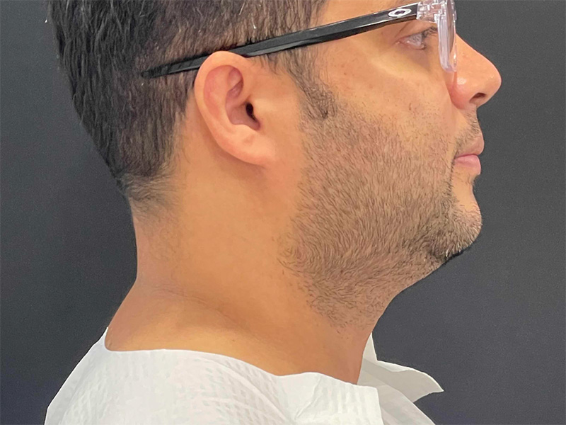Chin Liposuction Before Right